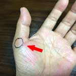 左手親指の第2関節